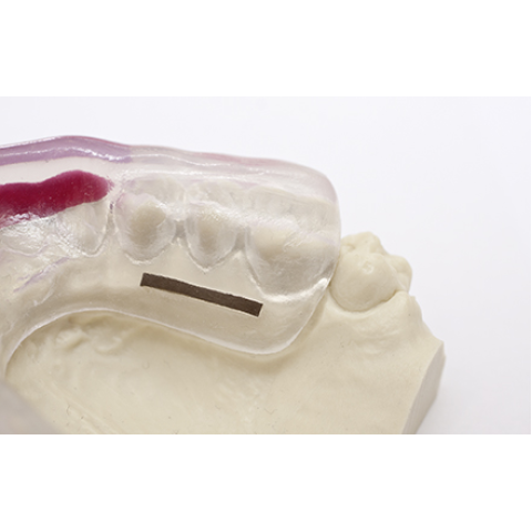 Fasie opaca X-ray - Dreve